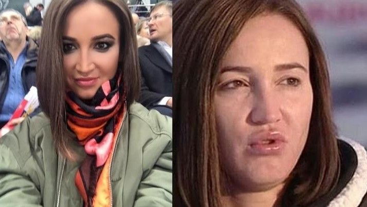 Ольга Бузова шокировала пользователей Instagram опухшим лицом