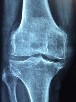 Дискомфорт в коленях: 5 симптомов начинающегося артрита