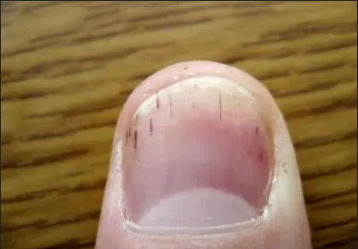 Темные полоски на ногтях являются признаком серьезных проблем со здоровьем